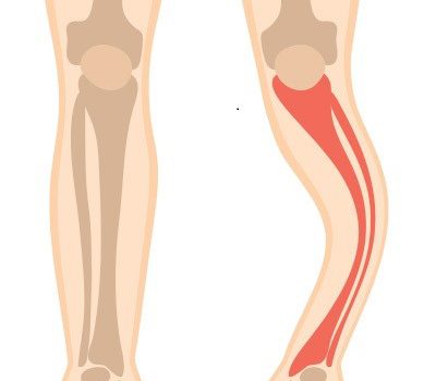 پاژه استخوانی در ساق پا